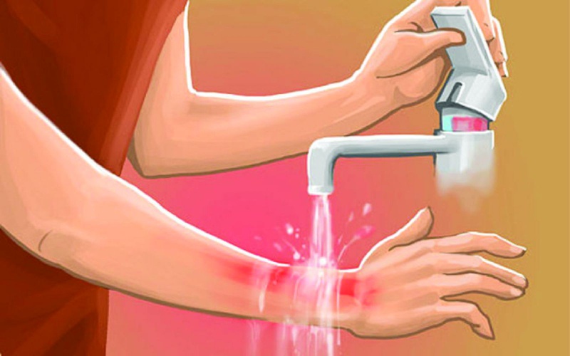 Cách sơ cứu bỏng nước sôi hiệu quả nhất 1