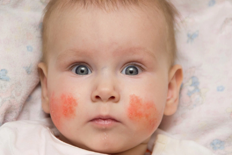 cách trị chàm sữa theo dân gian 1