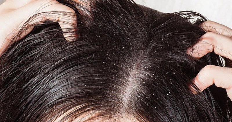 cách trị chấy cho trẻ 1
