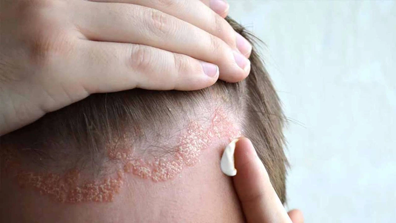 Cách trị chấy rận bằng dấm an toàn và hiệu quả 3