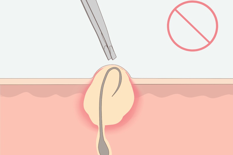 Cách trị lông mọc ngược ở chân cực đơn giản và hiệu quả 1