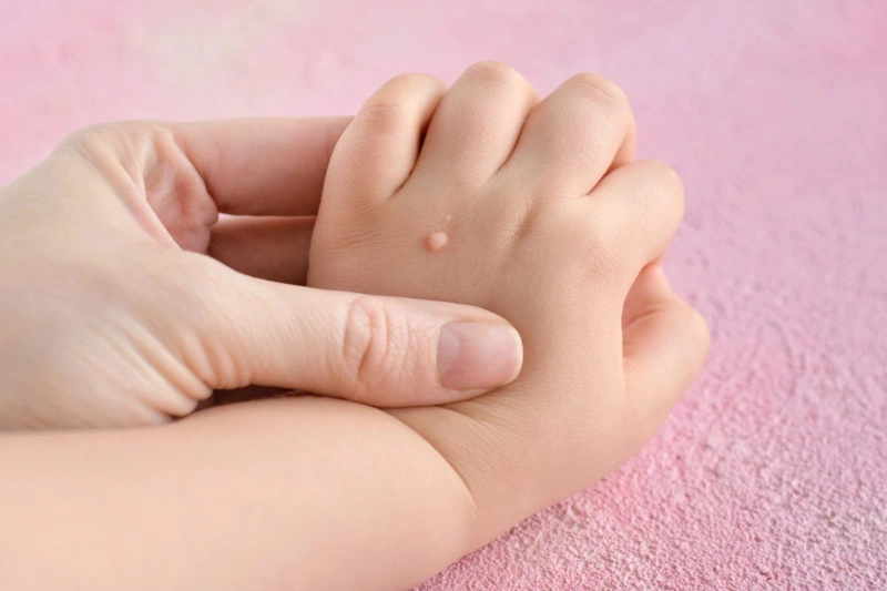 Cách trị mụn cóc tại nhà dân gian nhiều người chưa biết 1