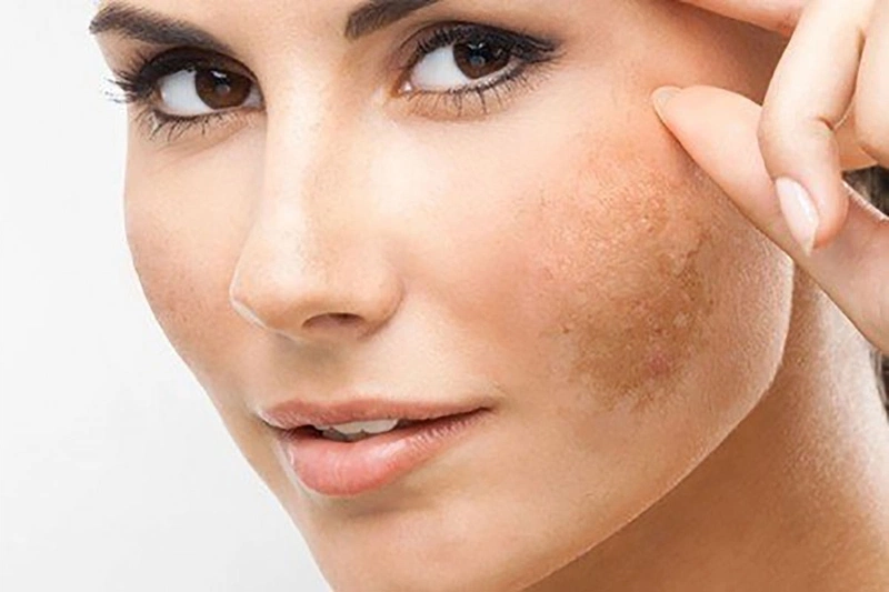 Cách trị nám bằng dầu dừa