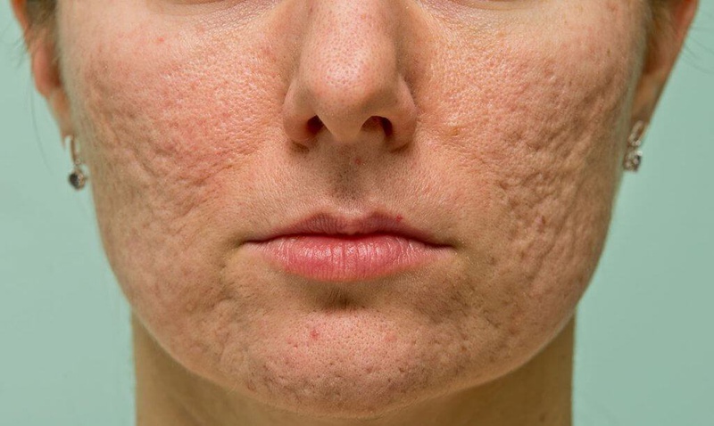trị sẹo lõm lâu năm bằng rau má 1