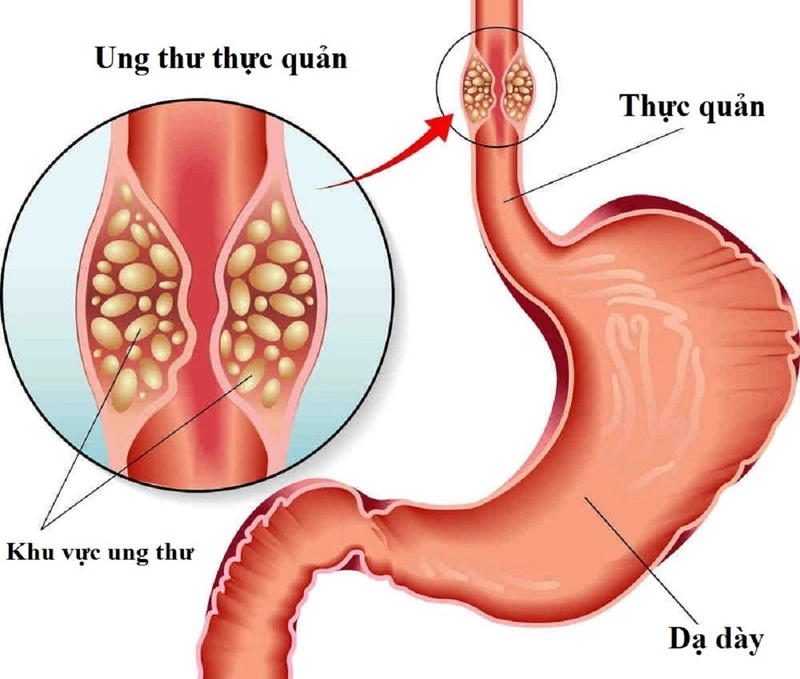 Cách trị trào ngược dạ dày khó thở trước khi biến chứng nguy hiểm 2