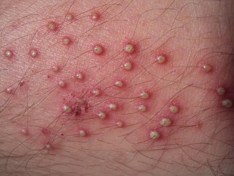 Cách trị viêm nang lông ở chân bằng cám gạo1