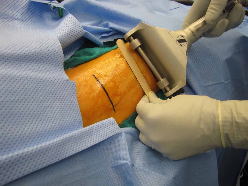 Cách xóa xăm với phương pháp phẫu thuật cắt bỏ