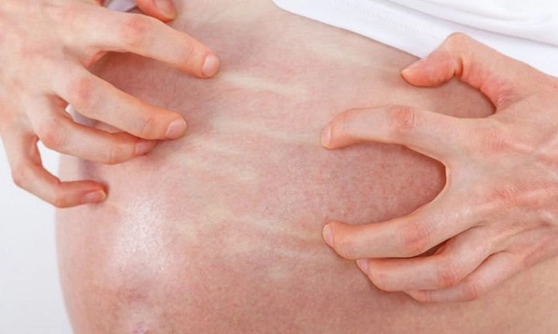 Tư vấn thông tin: Dị ứng hải sản ở bà bầu và các cách xử lý 3