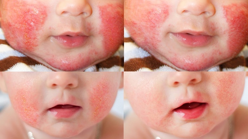 Cách xử lý bệnh chàm bội nhiễm ở trẻ em 1