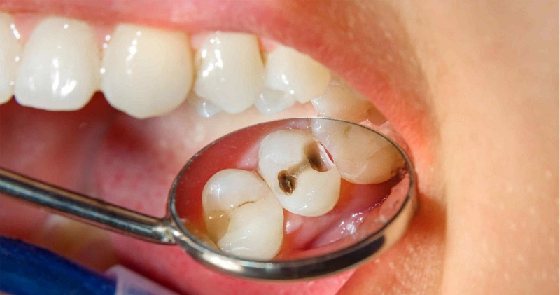 Cách xử lý sâu kẽ răng nhanh chóng, hiệu quả nhất 1