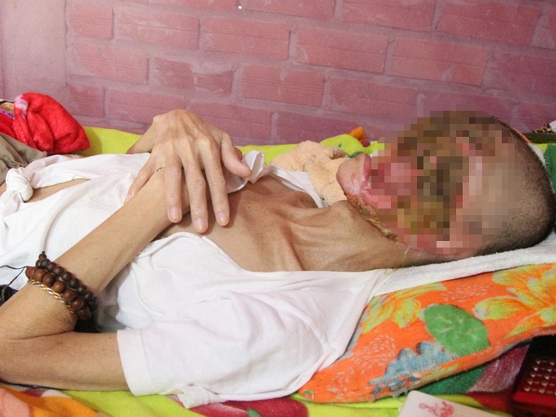 Cam tẩu mã là gì? Nguyên nhân và triệu chứng của bệnh1