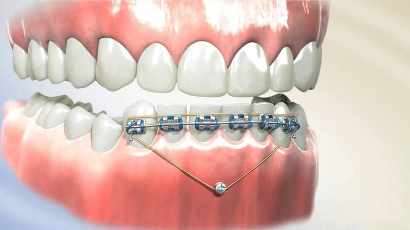 Cắm vít niềng răng hay còn gọi với tên khác là minivis