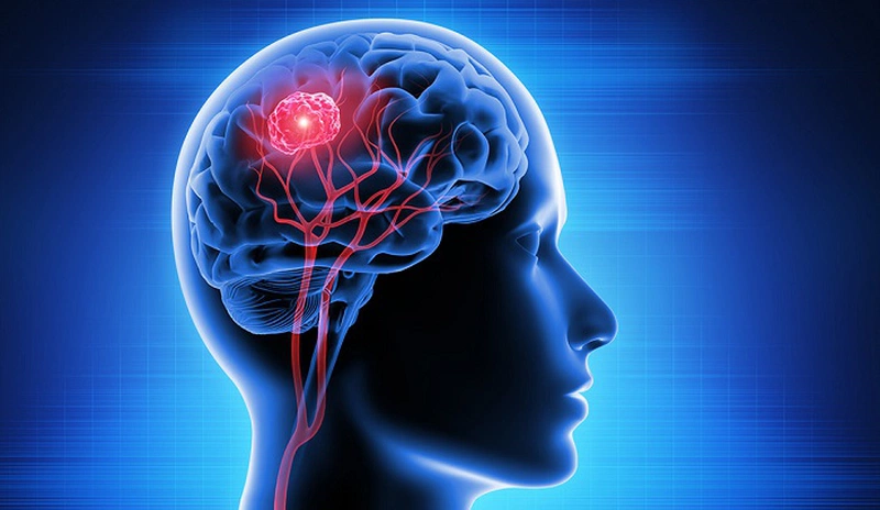 Căn bệnh u não ác tính có chữa được không?