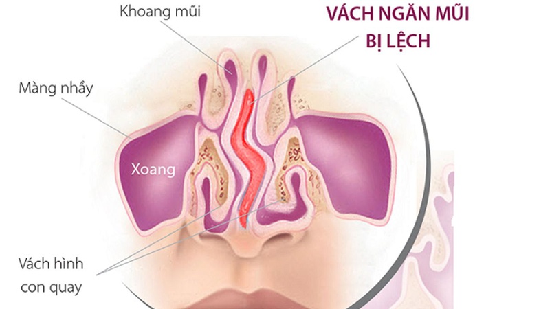 Cần cải thiện tư thế ngủ khi nghẹt mũi như thế nào? 1