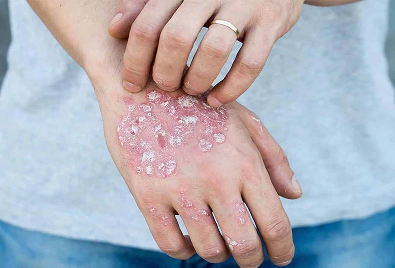 Cần làm gì để tránh làm hắc lào lan rộng 3