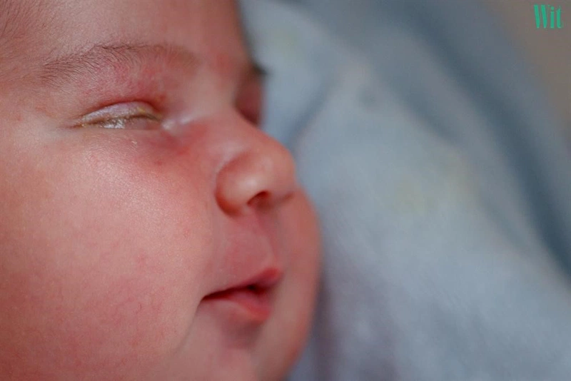 Cần làm gì khi trẻ sơ sinh bị đau mắt đỏ? 4