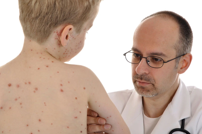 Cần lưu ý khi xử lý bệnh nhân bị thủy đậu 1