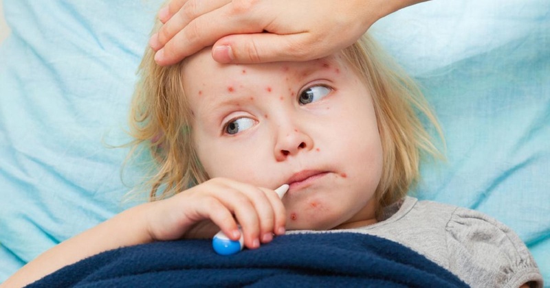Cần lưu ý khi xử lý bệnh nhân bị thủy đậu 3
