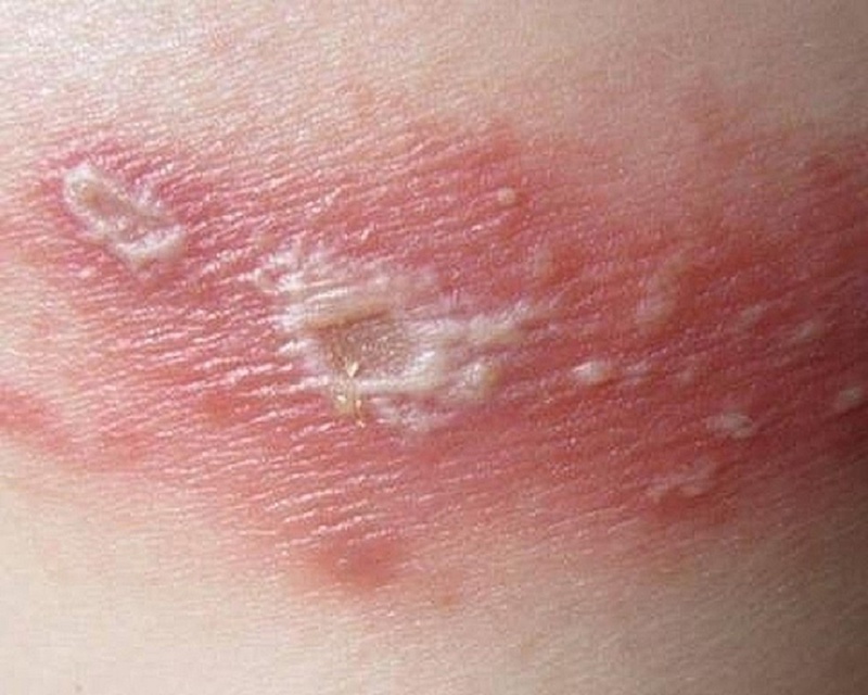 Cẩn thận kiến ba khoang vào mùa mưa, chất độc gây biến chứng 2