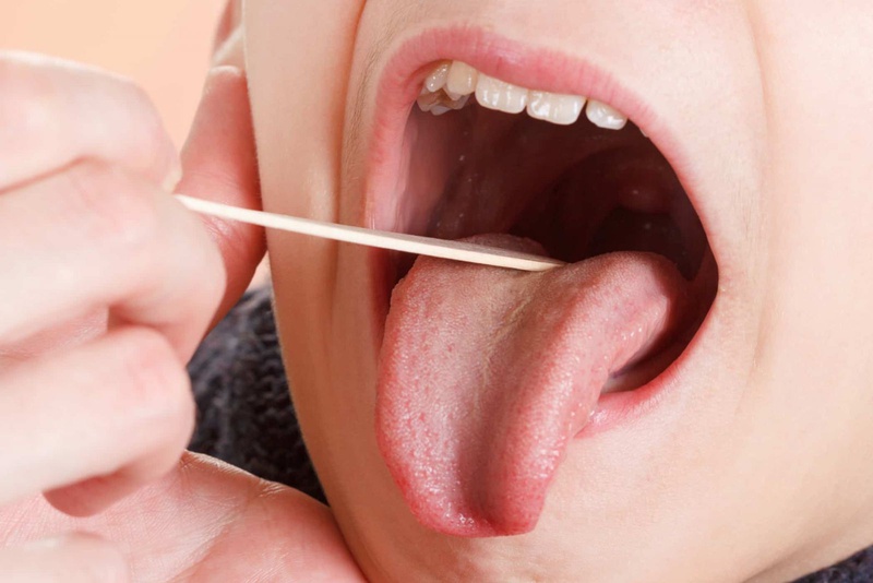 Cẩn thận nguy cơ viêm amidan gây khó thở 3