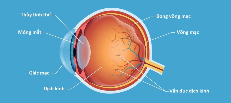 Cận thị có dẫn đến mù lòa không 2