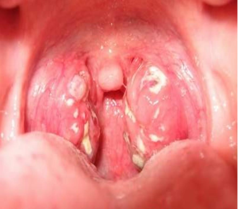Cần uống gì khi bị viêm họng để nhanh khỏi 1