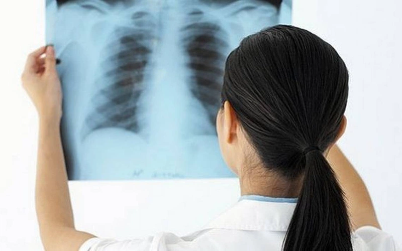 chụp x quang phổi xác định lao phổi