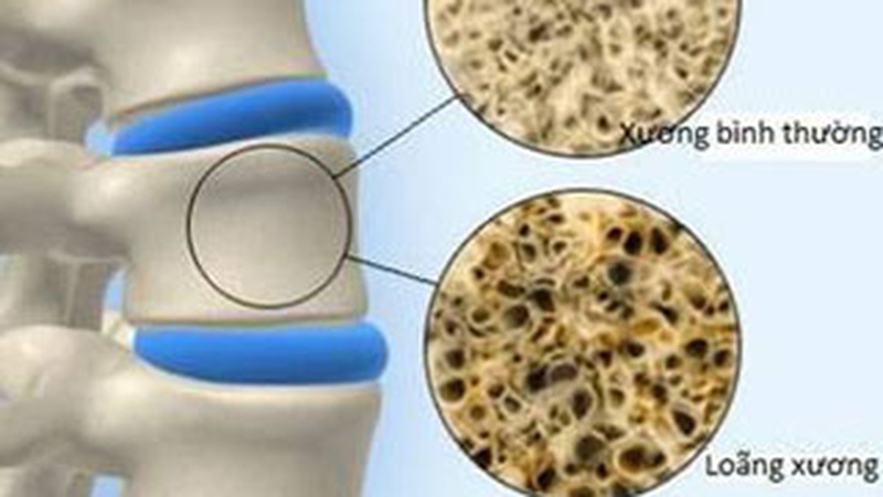 Cảnh báo việc cơ thể thiếu canxi kéo dài và những tác hại ngiêm trọng đối với cơ thể 2