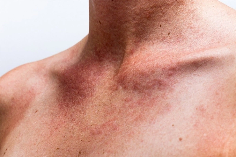 Dấu hiệu cho thấy bạn bị dị ứng với rượu vang 1