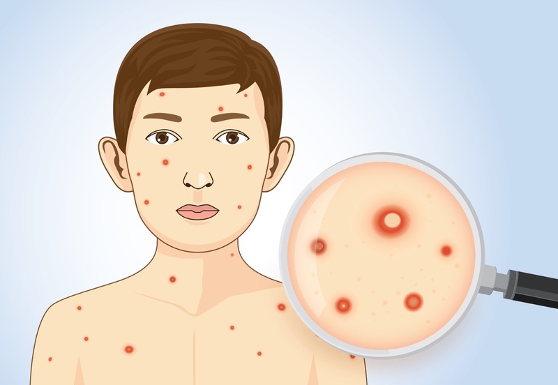 Cảnh giác với thủy đậu và những biến chứng của bệnh 2