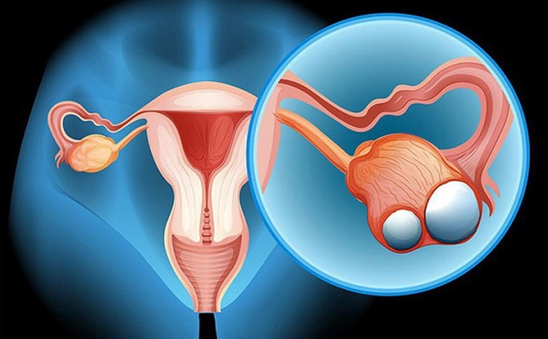 Cắt 1 bên buồng trứng có con được không - Chị em cần biết! 2