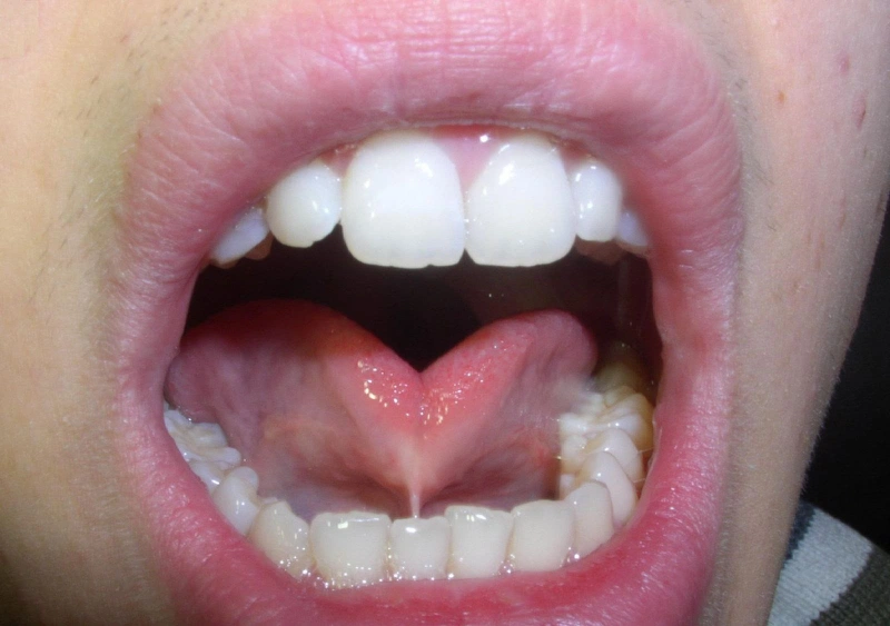 Cắt dính thắng lưỡi ở người lớn được thực hiện thế nào?1
