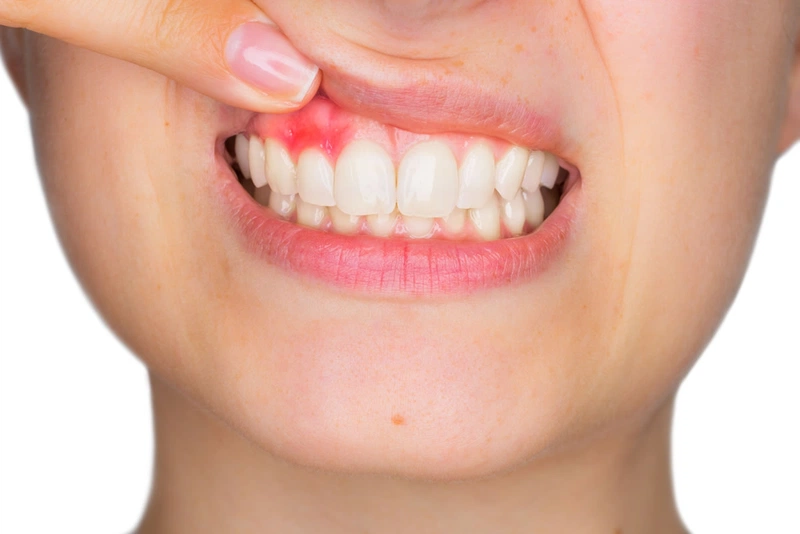 Cắt lợi có hại không? Nguy hiểm khi cắt lợi ở nha khoa chất lượng kém 1