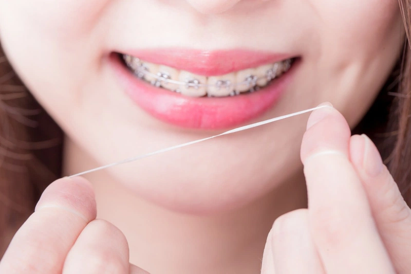Cắt lợi khi niềng răng có được không? Niềng răng có hết hở lợi không? 3