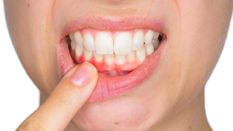 Cắt lợi là gì? Đang niềng răng có cắt lợi được không1