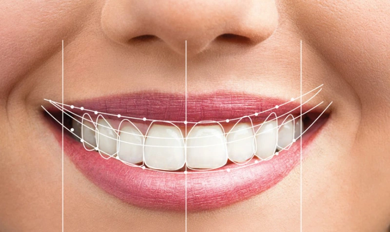 Cắt lợi thẩm mỹ là gì Có nguy hiểm không 2