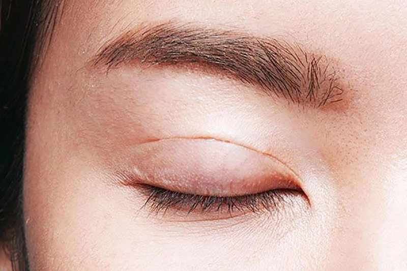 Cắt mí bao lâu thì được rửa mặt? Bạn đã biết cách vệ sinh mí mắt sau phẫu thuật chính xác chưa? 2