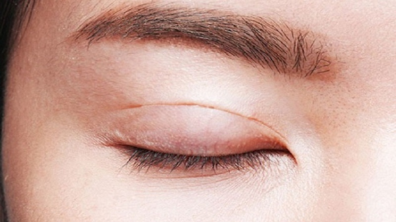 Mức độ ảnh hưởng đến mô da phụ thuộc vào đặc điểm cơ địa và lượng thịt bò ăn