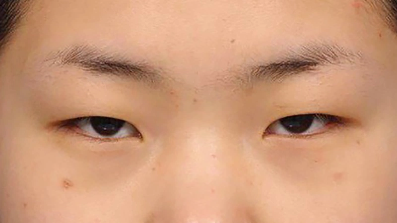 Cắt mí mắt có đau không? Bao lâu thì khỏi? 1