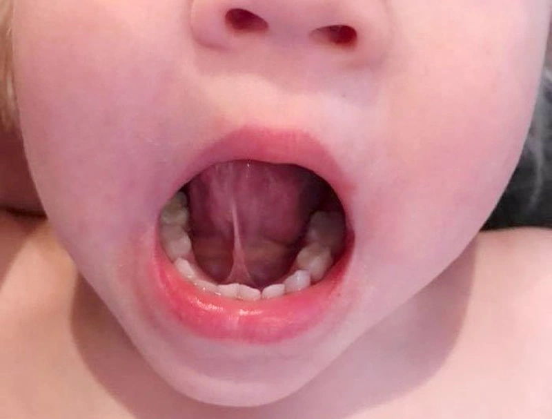 Dính thắng lưỡi ở trẻ 3 tuổi - Xử lý như thế nào? 3
