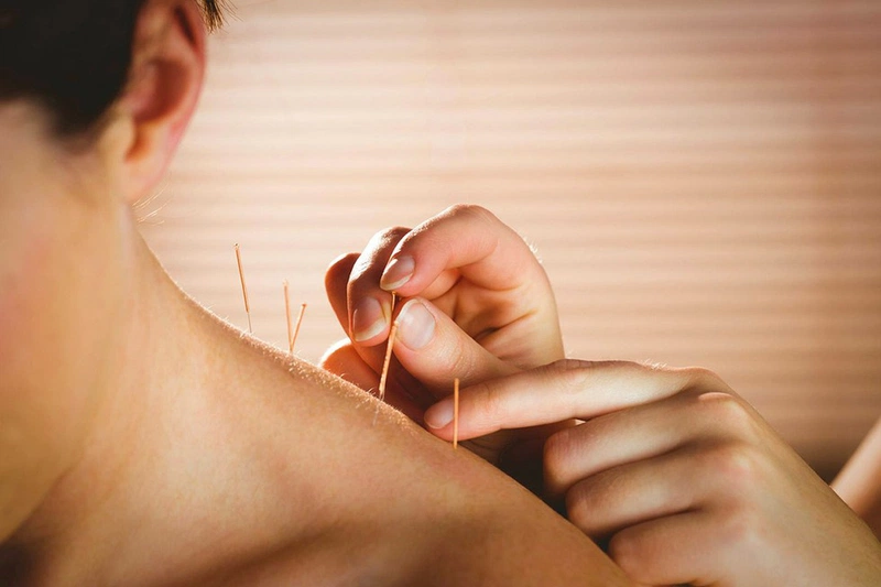 Châm cứu trị đau đầu có tốt không? Các huyệt châm cứu đau đầu1