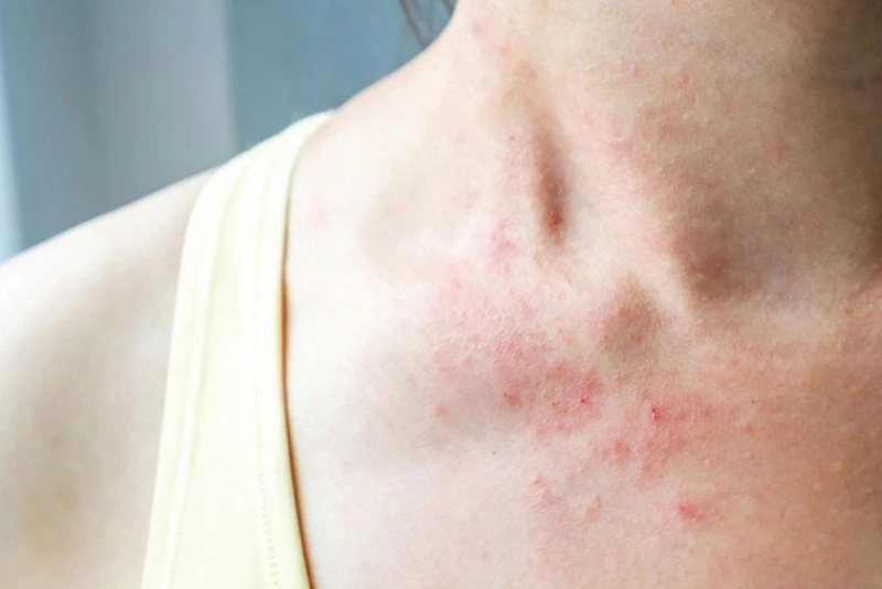 Bệnh chàm chủ yếu gây triệu chứng ngoài da và thường không ảnh hưởng nghiêm trọng đến sức khỏe