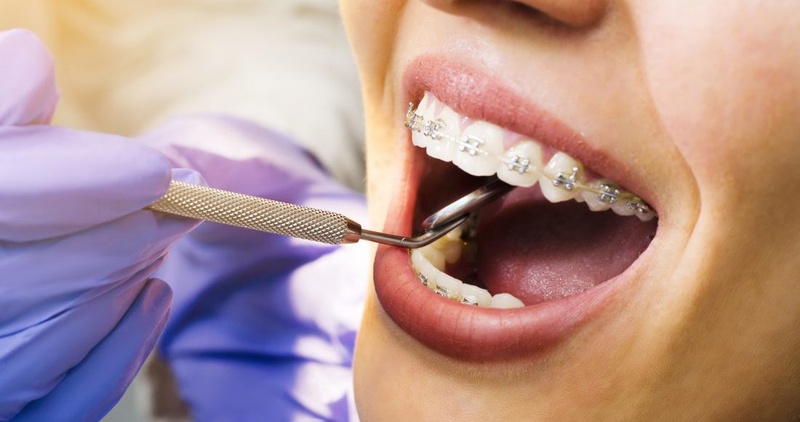 Phương pháp chăm sóc răng niềng hiệu quả 2