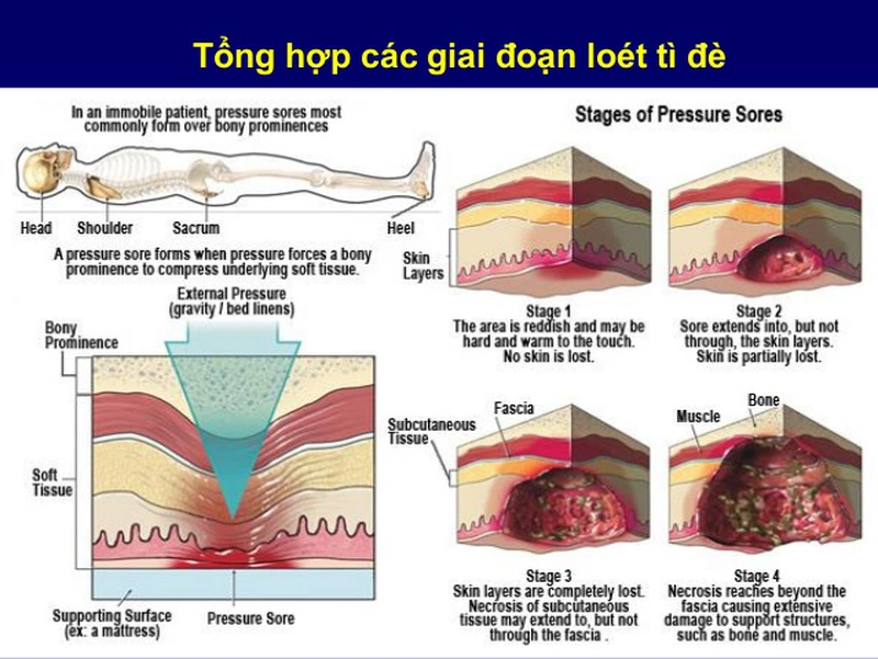 Chăm sóc sức khỏe: Thuốc bôi loét tỳ đè1