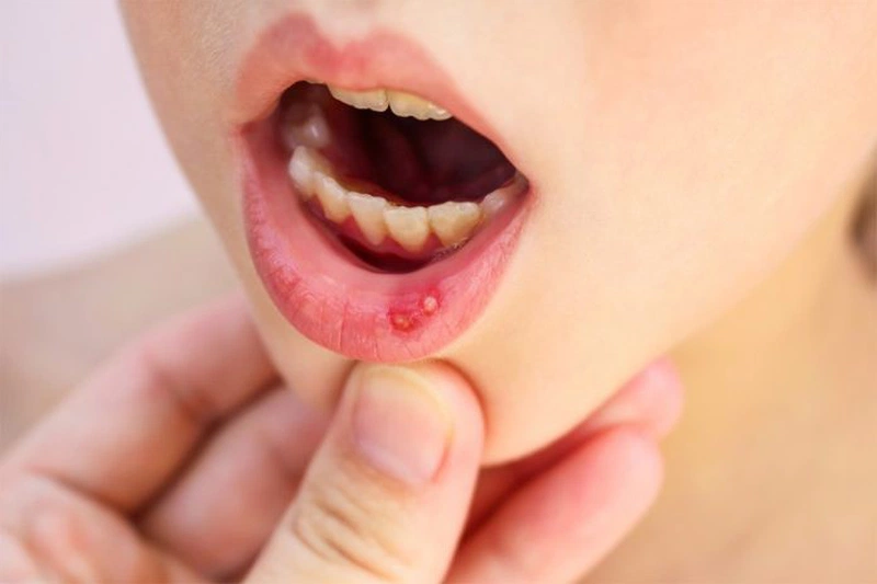Chạm tay vào thủy ngân có sao không? Cách xử lý thủy ngân an toàn bạn cần biết