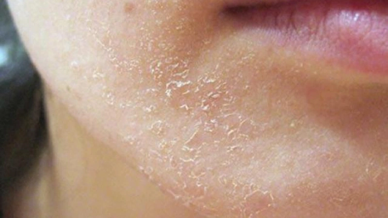 Chàm tổ đỉa lòng bàn chân có nguy hiểm không? 3