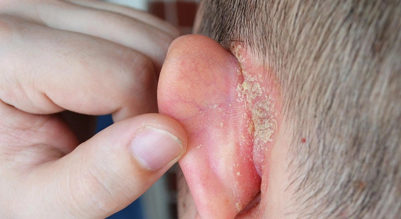 Chàm vành tai ở trẻ sơ sinh có nguy hiểm không và điều trị như thế nào