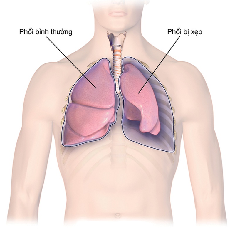 Chẩn đoán bệnh qua hình ảnh tràn khí màng phổi - Nhà thuốc FPT ...
