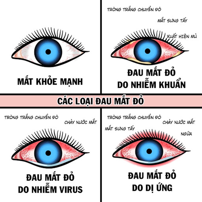 Chẩn đoán nguyên nhân và dấu hiệu của bệnh đau mắt đỏ ở bé