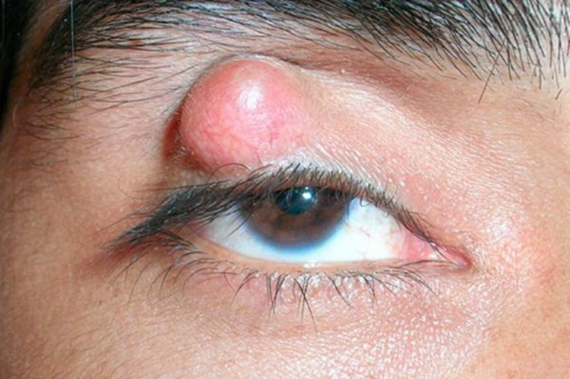 Bệnh viêm mi mắt là gì? Những điều cần biết về viêm mi mắt 2